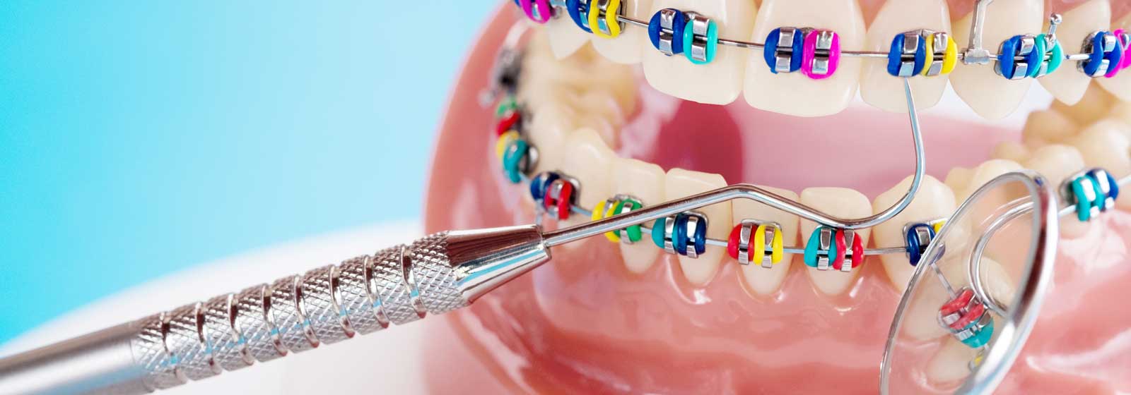 Types of Braces - Colorful braces with mirror and pick